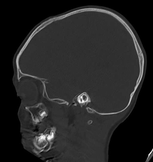 Acute mastoiditis (Radiopaedia 82678-96881 Sagittal bone window 20).jpg
