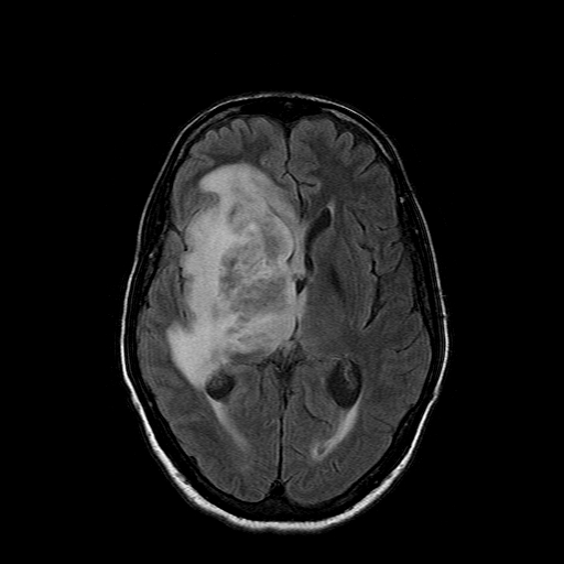 File:Acute necrotizing toxoplasma encephalitis (Radiopaedia 10683-11149 Axial FLAIR 9).jpg