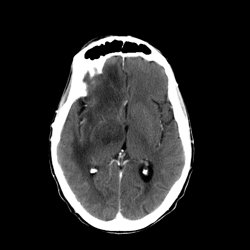 File:Acute necrotizing toxoplasma encephalitis (Radiopaedia 10683-11150 C+ arterial phase 17).jpg