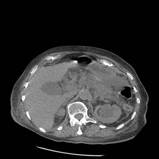 Acute on chronic pancreatitis (Radiopaedia 13233-13244 Axial non-contrast 25).jpg