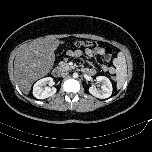 Acute on chronic pancreatitis (Radiopaedia 80902-94423 Axial C+ portal venous phase 71).jpg