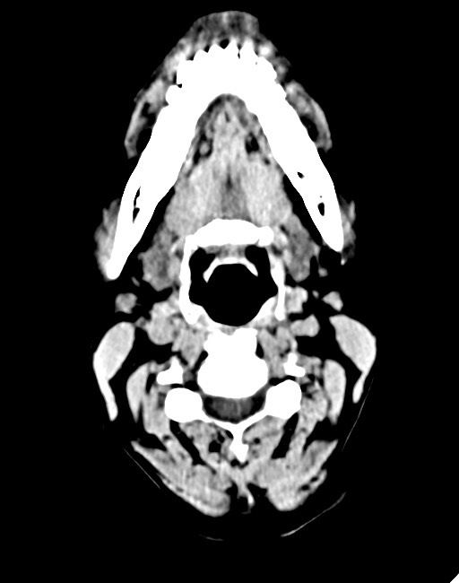 Acute on chronic subdural hematoma (Radiopaedia 74814-85823 Axial non-contrast 9).jpg