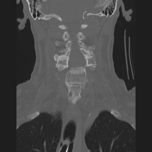 Acute on chronic subdural hematoma and thoracic vertebral injury in a multitrauma patient (Radiopaedia 31698-32619 Axial bone window 1).jpg