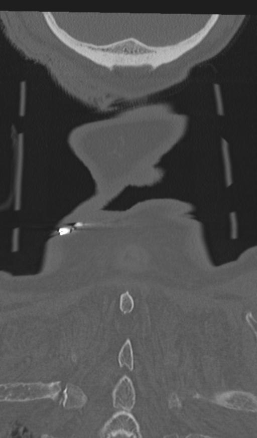 Acute on chronic subdural hematoma and thoracic vertebral injury in a multitrauma patient (Radiopaedia 31698-32619 Coronal bone window 70).jpg