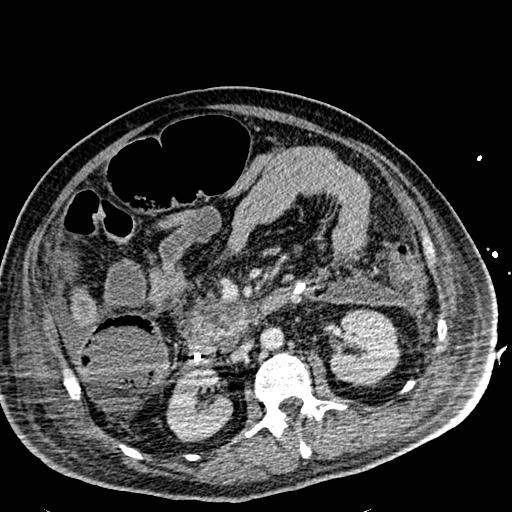 Acute pancreatic necrosis (Radiopaedia 13560-18501 Axial C+ portal venous phase 64).jpg