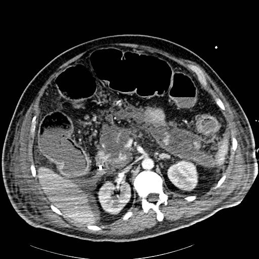 Acute pancreatic necrosis (Radiopaedia 13560-18502 Axial C+ portal venous phase 30).jpg