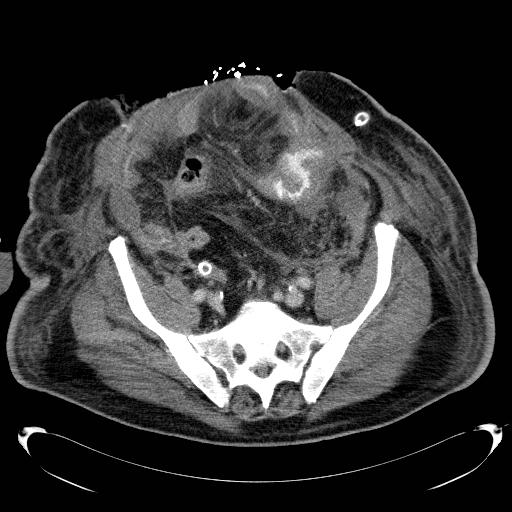 Acute pancreatic necrosis (Radiopaedia 13560-18503 Axial C+ portal venous phase 62).jpg
