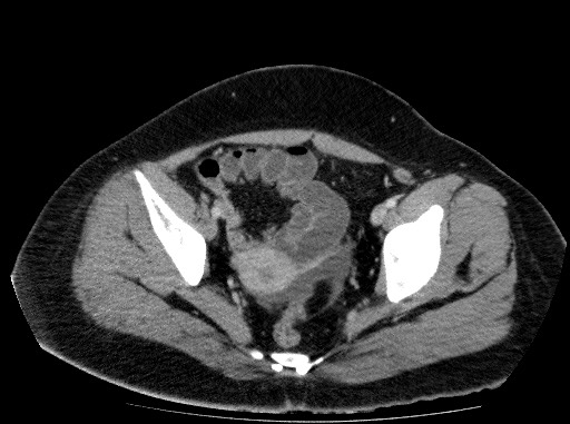 File:Acute pancreatitis (Radiopaedia 69236-79012 Axial C+ portal venous phase 80).jpg