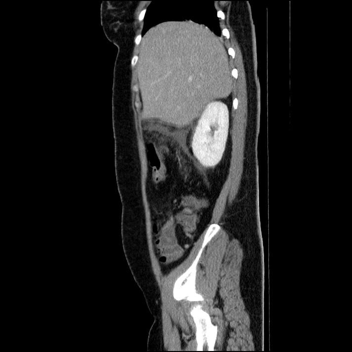 Acute pancreatitis (Radiopaedia 69236-79012 Sagittal C+ portal venous phase 75).jpg