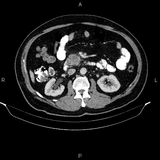 Acute pancreatitis (Radiopaedia 85390-101010 Axial C+ portal venous phase 46).jpg