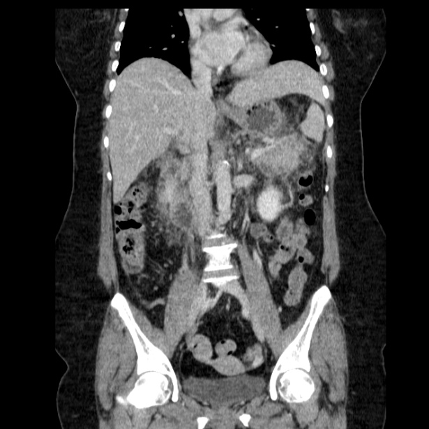Acute pancreatitis - Balthazar C (Radiopaedia 26569-26714 Coronal C+ portal venous phase 36).jpg
