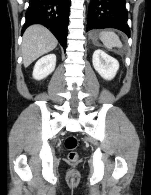 Acute pancreatitis - Balthazar E (Radiopaedia 23080-23110 Coronal C+ portal venous phase 59).jpg