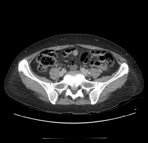 Acute pancreatitis - Balthazar E - post ERCP (Radiopaedia 27562-27772 Axial C+ portal venous phase 54).png