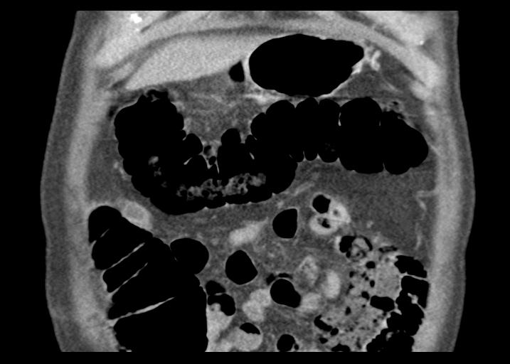 Acute pancreatitis and walled-off necrosis (Radiopaedia 29888-30403 Coronal C+ portal venous phase 13).jpg