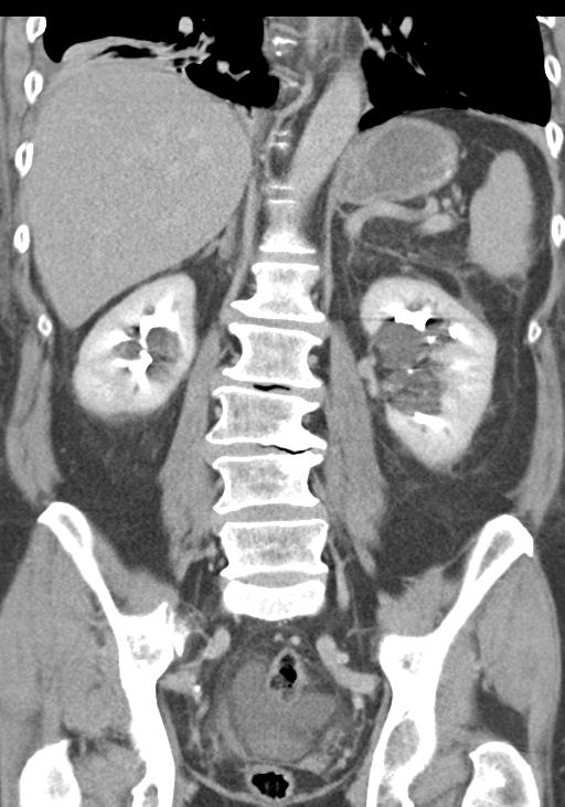 Acute pancreatitis and walled-off necrosis (Radiopaedia 29888-30403 E 38).jpg