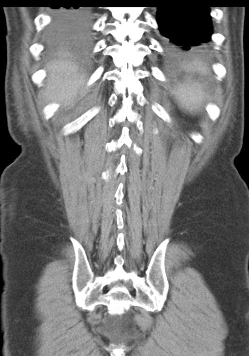 Acute pancreatitis and walled-off necrosis (Radiopaedia 29888-30403 E 48).jpg