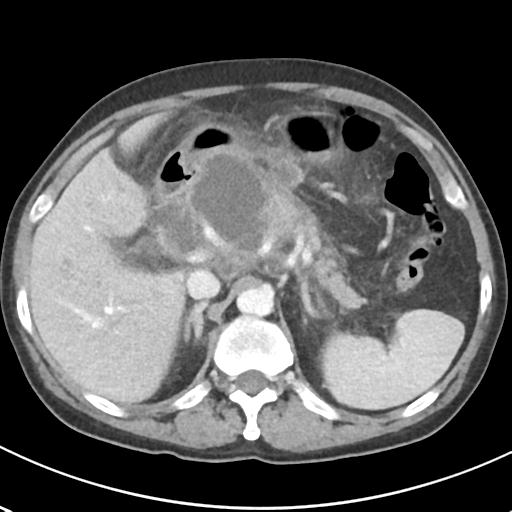 File:Acute pancreatitis and walled-off necrosis (Radiopaedia 29888-30404 Axial C+ portal venous phase 23).jpg