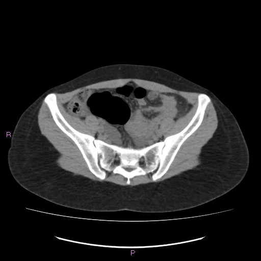 Acute pancreatitis secondary to stone at minor papilla and pancreatic divisum (Radiopaedia 76570-88333 Axial non-contrast 59).jpg