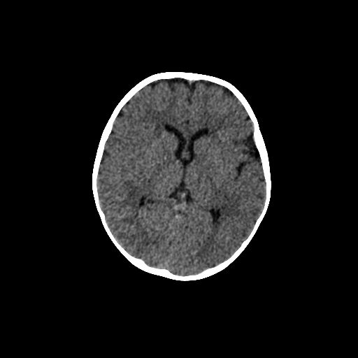 Acute phase of hemiconvulsion-hemiplegia epilepsy syndrome (Radiopaedia 29309-29744 Axial non-contrast 26).jpg
