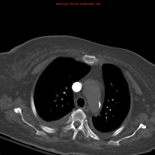 Acute pulmonary embolism (Radiopaedia 13286-13289 Axial C+ CTPA 21).jpg