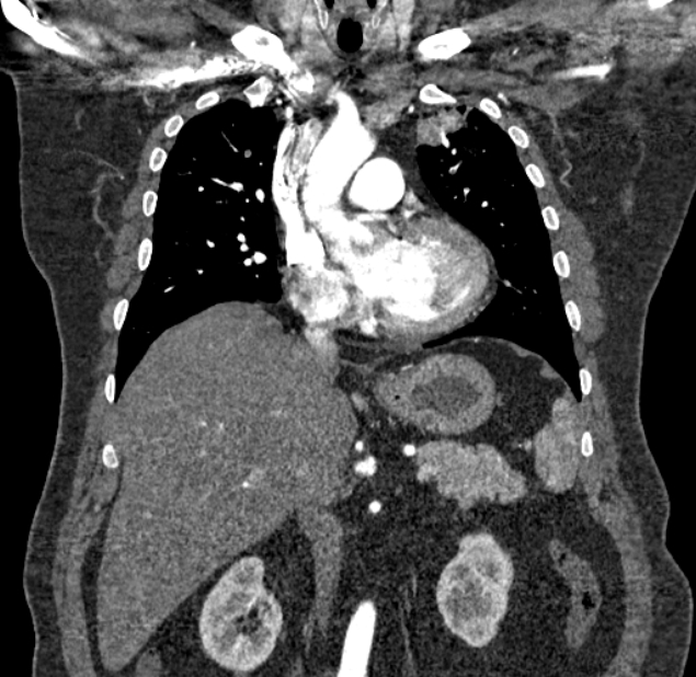 Acute pulmonary embolism with pulmonary infarcts (Radiopaedia 77688-89908 Coronal C+ CTPA 36).jpg