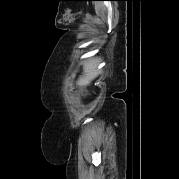 Acute pyelonephritis (Radiopaedia 25657-25837 Sagittal renal parenchymal phase 16).jpg