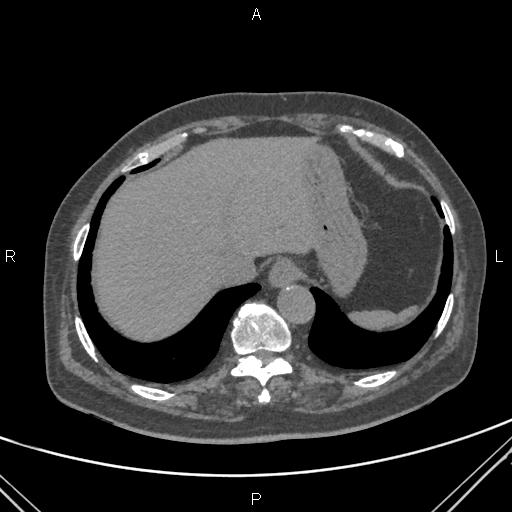 Acute renal artery occlusion (Radiopaedia 86586-102682 Axial non-contrast 7).jpg