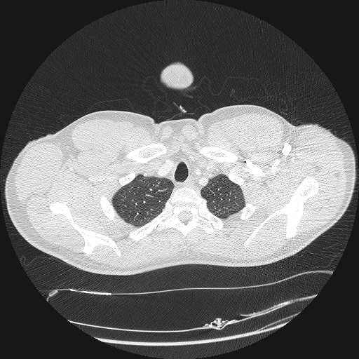 Acute segmental pulmonary emboli and pulmonary infarction (Radiopaedia 62264-70444 Axial lung window 13).jpg