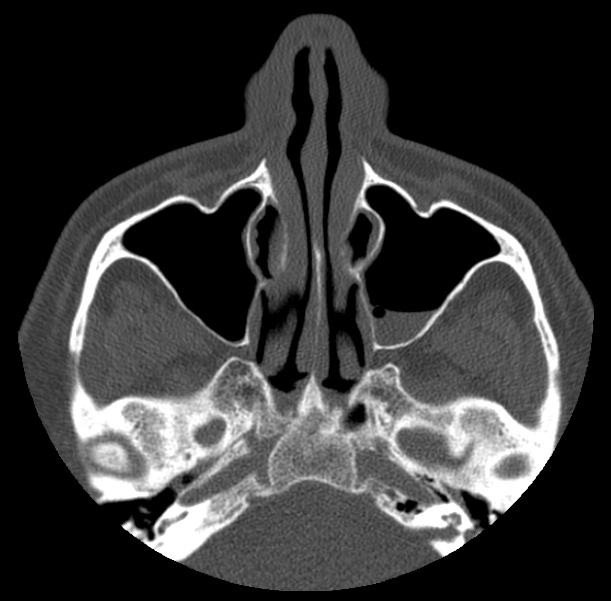 Acute sinusitis (Radiopaedia 23161-23215 Axial bone window 27).jpg
