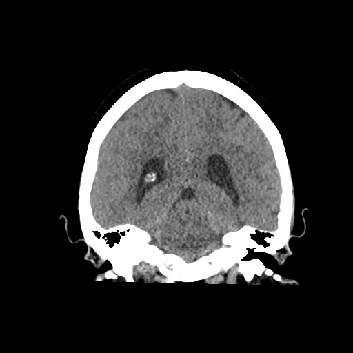 Acute subarachnoid hemorrhage and accessory anterior cerebral artery (Radiopaedia 69231-79008 Coronal non-contrast 46).jpg