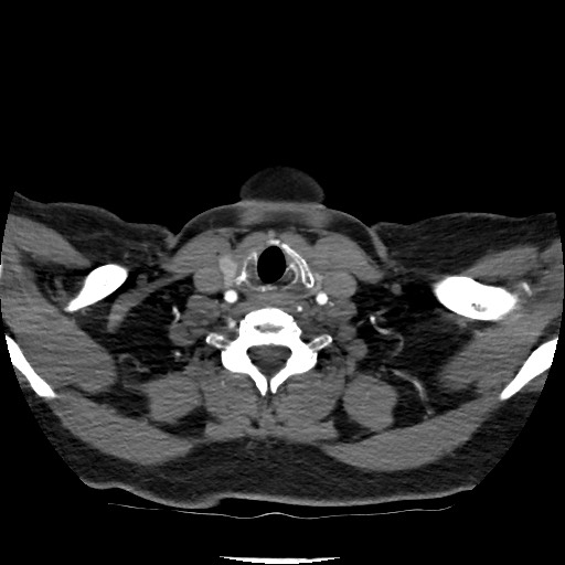 Acute subarachnoid hemorrhage and accessory anterior cerebral artery (Radiopaedia 69231-79009 Axial C+ arterial phase 37).jpg