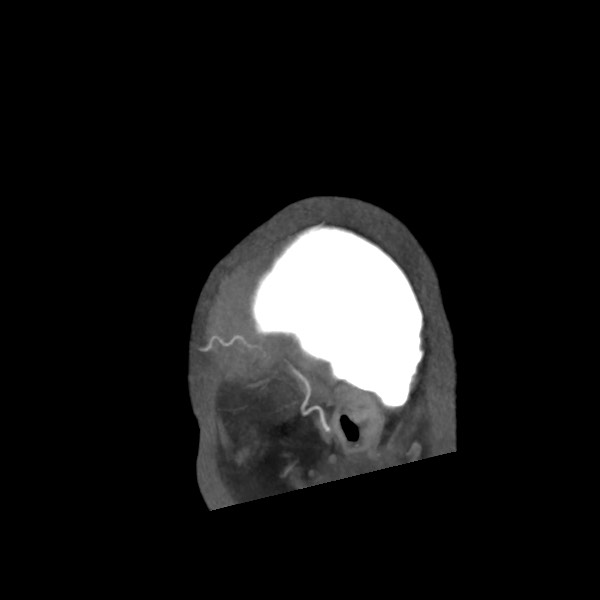 File:Acute subarachnoid hemorrhage and accessory anterior cerebral artery (Radiopaedia 69231-79009 Sagittal C+ arterial phase 68).jpg