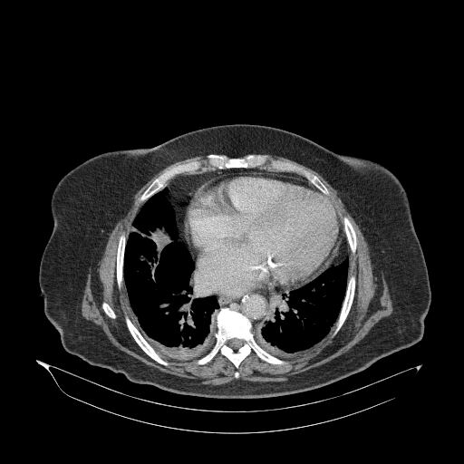File:Acute superior mesenteric artery occlusion (Radiopaedia 51288-56960 Axial C+ portal venous phase 1).jpg