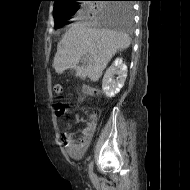 Acute tubular necrosis (Radiopaedia 28077-28334 H 28).jpg