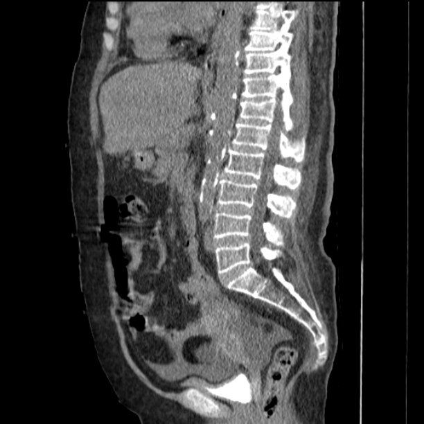 Acute tubular necrosis (Radiopaedia 28077-28334 Sagittal non-contrast 47).jpg