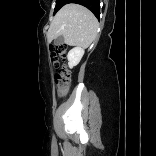 Acute uncomplicated appendicitis (Radiopaedia 73704-84499 Sagittal C+ portal venous phase 71).jpg