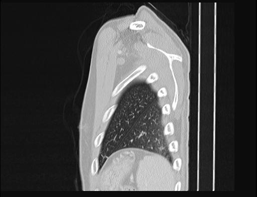 Addison disease (Radiopaedia 49318-54412 Sagittal lung window 6).jpg