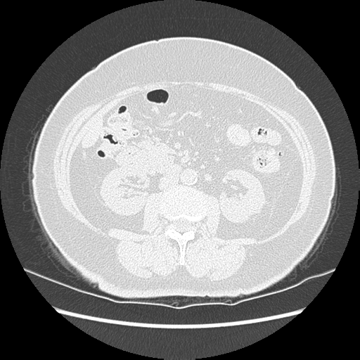 Adenocarcinoma in situ of lung (Radiopaedia 38685-40829 B 271).png