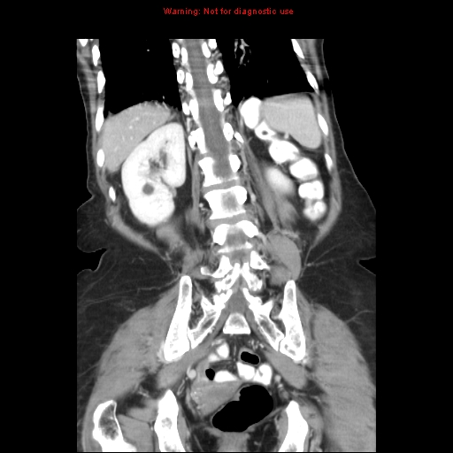 File:Adenocarcinoma of the colon (Radiopaedia 8191-9039 Coronal liver window 35).jpg