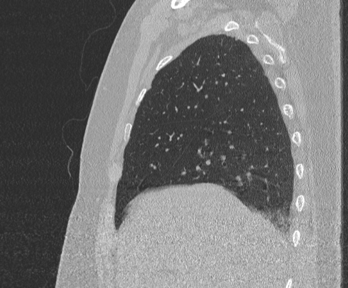 Adenoid cystic carcinoma of the trachea (Radiopaedia 49042-54137 Sagittal lung window 118).jpg