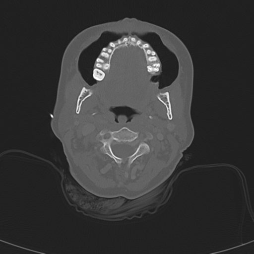 File:Adenoid cystic tumor of palate (Radiopaedia 46980-51518 Axial bone window 32).png