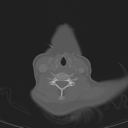Adenoid cystic tumor of palate (Radiopaedia 46980-51518 Axial bone window 51).png