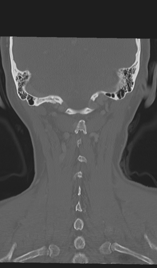 Adenoid cystic tumor of palate (Radiopaedia 46980-51518 Coronal bone window 49).png