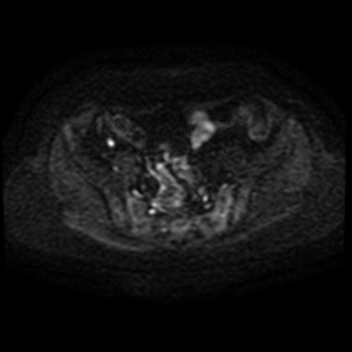 Adenoma malignum of cervix (Radiopaedia 66441-75705 Axial DWI 54).jpg