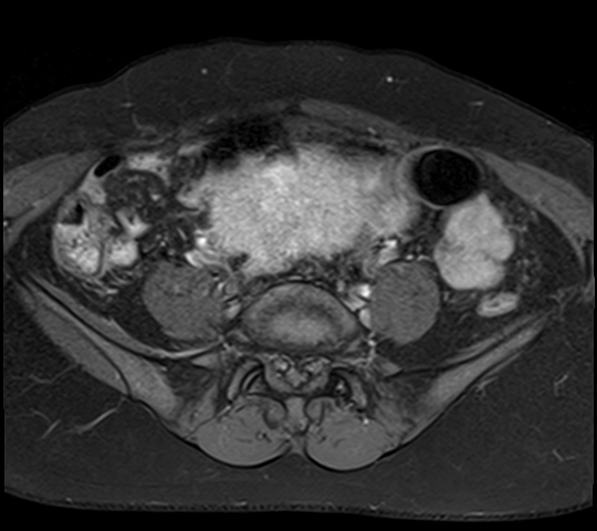 File:Adenomyosis - ovarian endometriomas (Radiopaedia 67031-76350 Axial T1 C+ fat sat 5).jpg