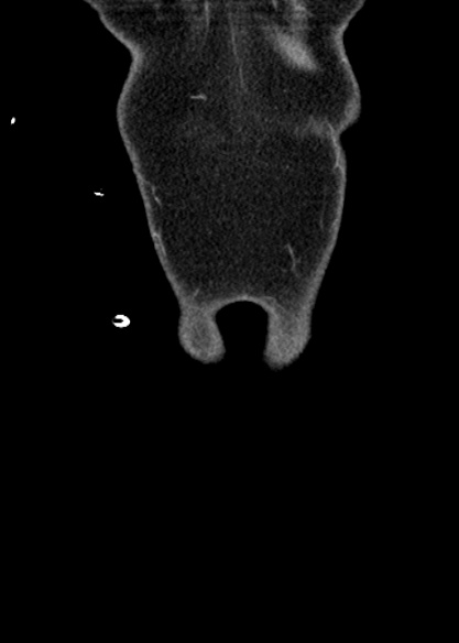 Adhesional small bowel obstruction (Radiopaedia 48397-53305 Coronal C+ portal venous phase 15).jpg