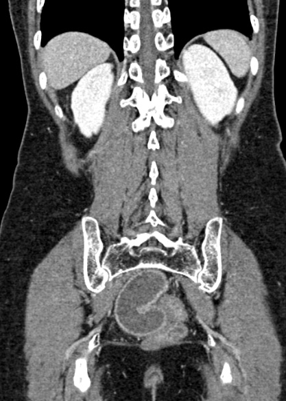 Adhesional small bowel obstruction (Radiopaedia 48397-53305 Coronal C+ portal venous phase 278).jpg
