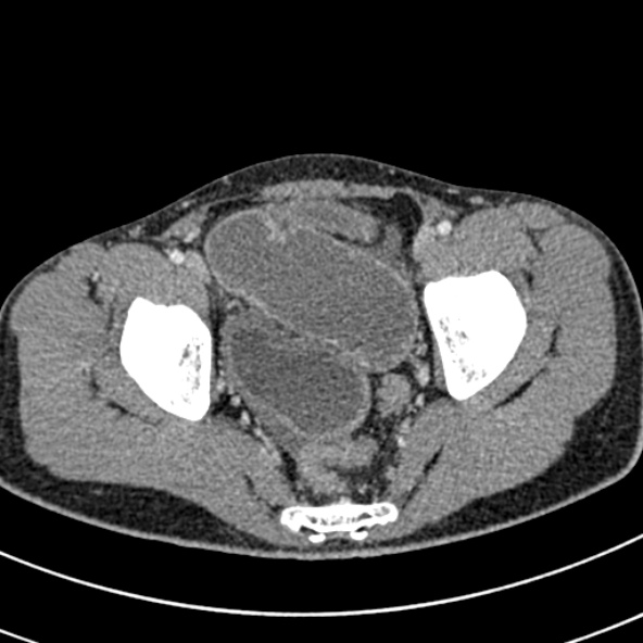 Adhesional small bowel obstruction (Radiopaedia 52107-57980 Axial C+ portal venous phase 114).jpg