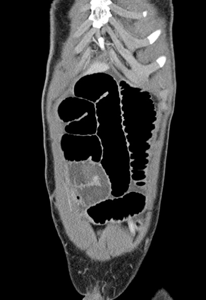File:Adhesional small bowel obstruction (Radiopaedia 52107-57980 Coronal C+ portal venous phase 10).jpg