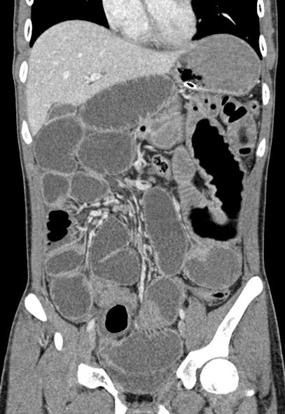 File:Adhesional small bowel obstruction (Radiopaedia 52107-57980 Coronal C+ portal venous phase 31).jpg